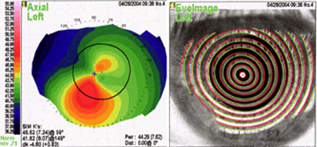 Corneal Topography for Keratoconus - David Wallace, MD 